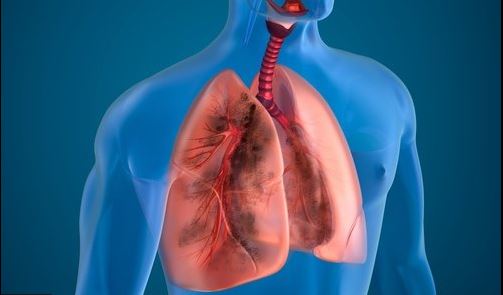 Thải độc phổi - Việc làm cần thiết mà bạn cần phải thực hiện ngay bây giờ để phòng tránh và cải thiện các bệnh lý nguy hiểm cho phổi.