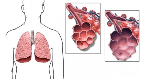 Những hiệu quả bất ngờ mà thải độc phổi mang đến cho sức khỏe con người.