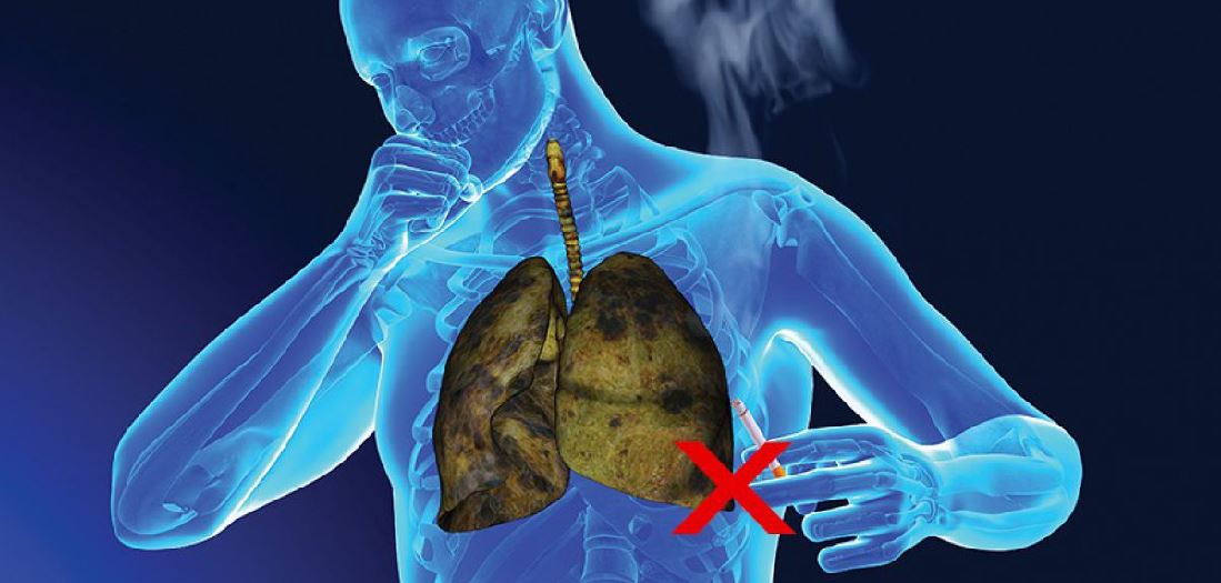 Những dấu hiệu sớm phát hiện ung thư phổi