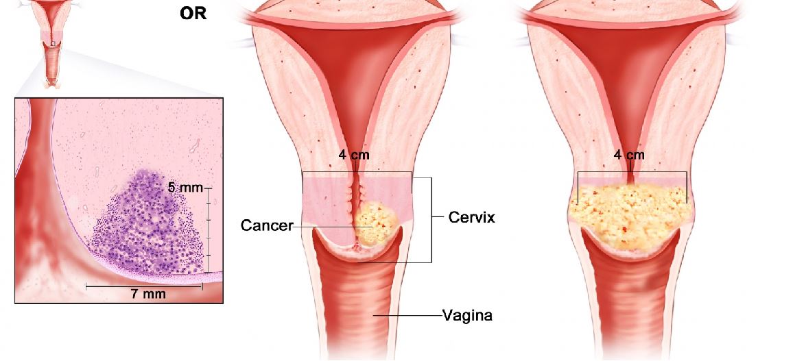 Đau vùng chậu là một trong những dấu hiệu cảnh báo ung thư cổ tử cung.