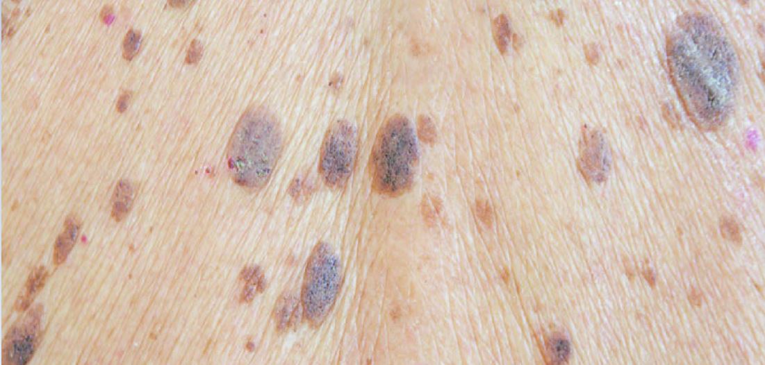 Kiểm tra da của bạn thường xuyên để xem có những bất thường gì mới không như nốt ruồi, tàn nhang và vết bớt.