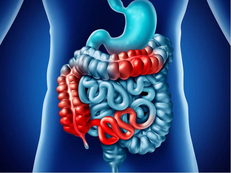 Bệnh Crohn gây ảnh hưởng tới hệ tiêu hóa gây ra đau bụng, tiêu chảy nặng, mệt mỏi, sụt cân và suy dinh dưỡng.
