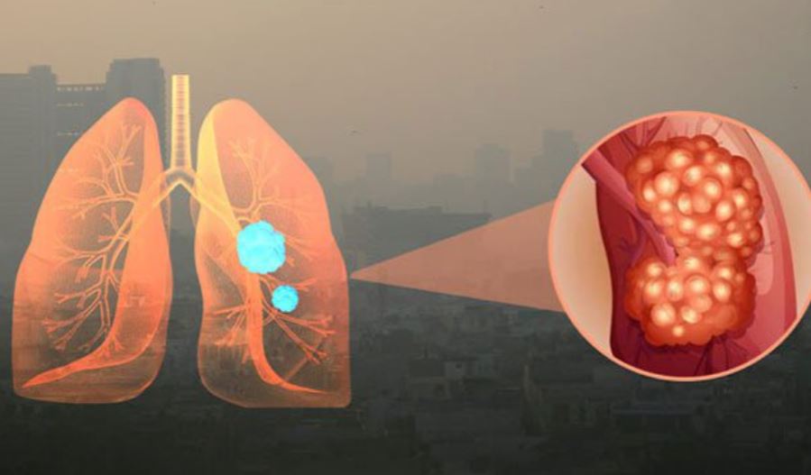 Ô nhiễm không khí gây ra các bệnh lý đường hô hấp